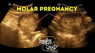 Molar Pregnancy  Hydatidiform Mole  Gestational Trophoblastic Disease  Ultrasound  Case 38 [upl. by Assiral]