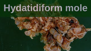 Complete Hydatidiform Mole  Pathology mini tutorial [upl. by Icrad]