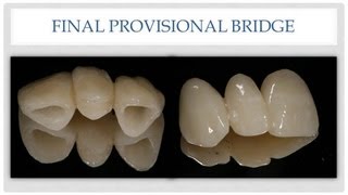 Dental Bridge The Esthetic Provisional Bridge [upl. by Nodnol]