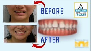 Invisalign Before and After Gap in Teeth [upl. by Isak]