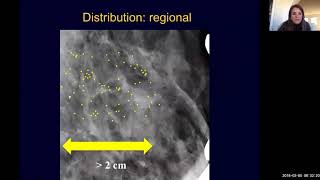 Breast Imaging Calcifications Basic Radiology [upl. by Kean]