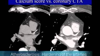 Protocol for Calcified Plaque in Your Arteries – Atherosclerosis – DrBerg [upl. by Swan]