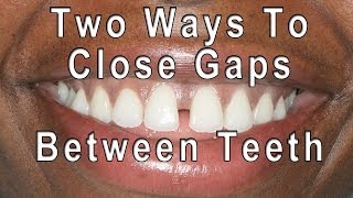 How to Close Gaps Between Teeth [upl. by Leopold756]