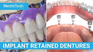 Implant retained dentures explained [upl. by Maclean]