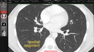 Bronchoscopy  examination of your airways English version [upl. by Namaan195]