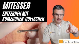 Mitesser entfernen mit Komedonenquetscher Wie geht das  Dr Kasten Hautmedizin in Mainz mitesser [upl. by Carlye]