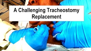 A Challenging Tracheostomy Replacement [upl. by Yerocaj760]