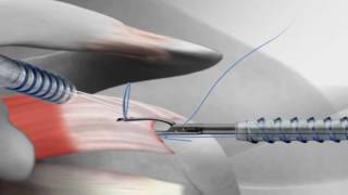 Rotator Cuff Repair with Arthrex® SutureBridge™ [upl. by Acillegna]