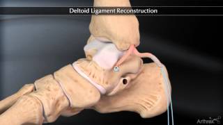 Deltoid Ligament Reconstruction [upl. by Aidnac]