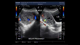 Ultrasound Video showing Hydatidiform Mole also called Molar Pregnancy [upl. by Ainavi]