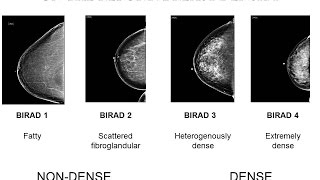 mamographic evaluation of breast calcifications part IV [upl. by Adihahs]