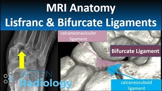 Lisfranc and Bifurcate Ligaments MRI Anatomy [upl. by Wulf]