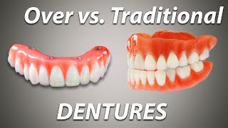 Over Denture vs Traditional Denture [upl. by Nnairam]