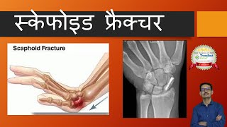 Scaphoid Fracture  All you want to know Hindi स्केफोइड फ्रैक्चर [upl. by Adabel]