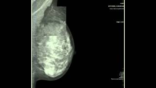 Microcalcifications Significance In My Mammograms  Dr Jay Harness [upl. by Latsryk]