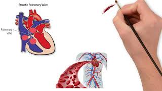 Aortic Stenosis  Heart Sounds  MEDZCOOL [upl. by Curley]