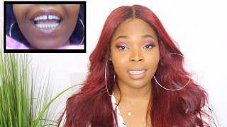 How To Close Gap Teeth Without Braces In 45 Mins  My Dental Bonding Experience [upl. by Michaeline]