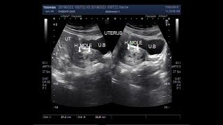 Ultrasound Video showing Molar Pregnancy also called Hydatidiform mole HM [upl. by Aicilyhp]