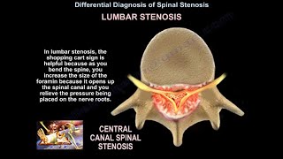 Symptoms of Cervical Stenosis  Jeffrey Cantor MD [upl. by Adnilim]