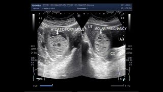 Ultrasound Video showing Hydatidiform Mole also called Molar Pregnancy [upl. by Jehoash838]