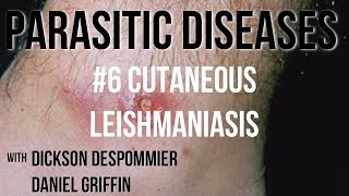 Parasitic Diseases Lectures 6 Cutaneous Leishmaniasis [upl. by Vasya230]