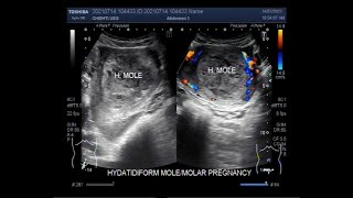 Complete Hydatidiform Mole also called Molar Pregnancy [upl. by Mcgrody]