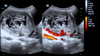 PARTIAL MOLAR PREGNANCY [upl. by Risan]