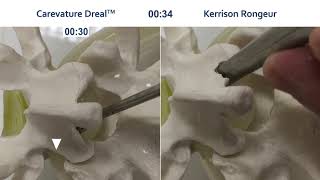 Decompression using Dreal® vs Kerrison Ronguers [upl. by Ethelstan]