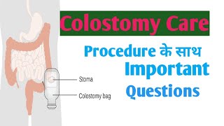 Colostomycare colostomy  Colostomy care [upl. by Conley812]