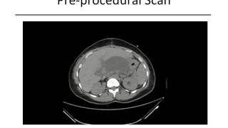 ImageGuided Percutaneous Drainage of Abnormal Abscesses and Fluid [upl. by Oisinoid959]