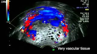 Early Pregnancy Scan  Molar pregnancy ultrasound [upl. by Nnyltiac]