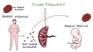 Understanding Rhesus Status and AntiD in Pregnancy [upl. by Qiratla]