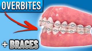 How Do BRACES FIX Overbites  Overbite Before and After Braces  Premier Orthodontics [upl. by Herwick384]