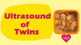 Sonography of Twins [upl. by Joell]