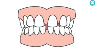 How To Close Gaps Between Teeth Without Braces [upl. by Kile]