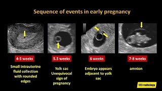 Early Pregnancy Failure A simplified Ultrasound Approach [upl. by Otho]