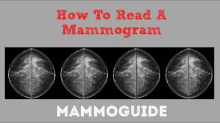 How To Read A Mammogram [upl. by Avitzur644]