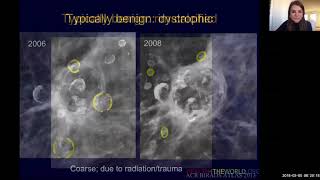 Breast ScreeningImaging for Cancer BIRADS Interpretation [upl. by Antipas398]