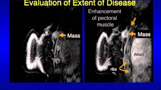 Which calcifications on mammogram are bad [upl. by Rann]