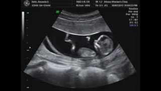 12w4d Twin Ultrasound with Movement amp Gender [upl. by Eniluap]